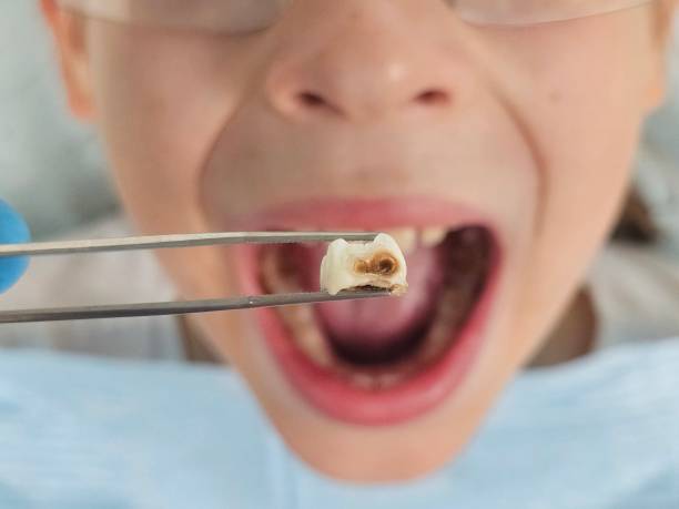 Best Emergency Tooth Extraction in Covelo, CA